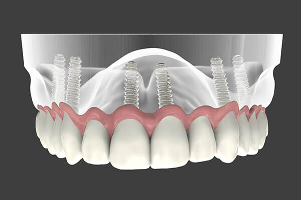 Implant Supported Dentures in Oklahoma