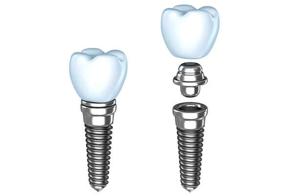 Single Tooth Dental Implants in Oklahoma